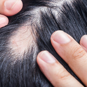 Alopecia Areata