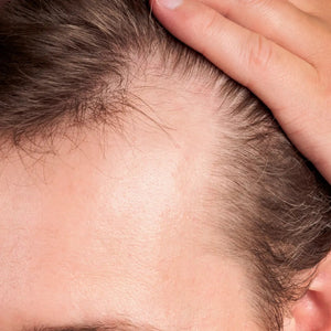 ANDROGENIC ALOPECIA