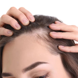 TELOGEN EFFLUVIUM